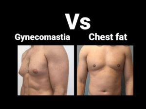 Difference Between Gynecomastia And Chest Fat - PharmEasy Blog